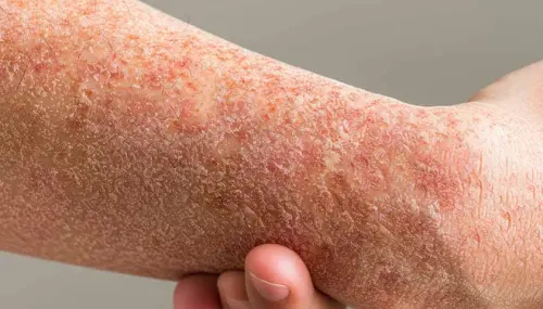 Что такое фотодерматит