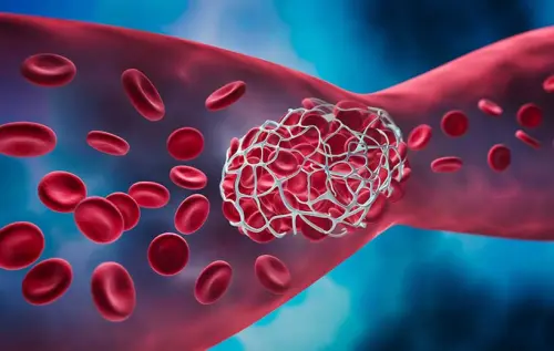 Чи може тромб розсмоктатися сам