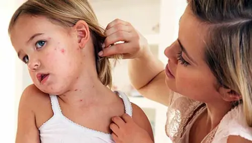 Причини харчової алергії у дітей та фактори ризику