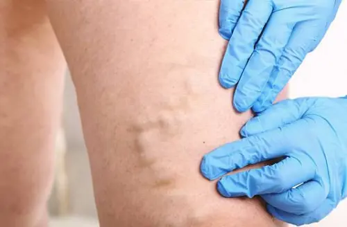 Як швидко розвивається тромбоз