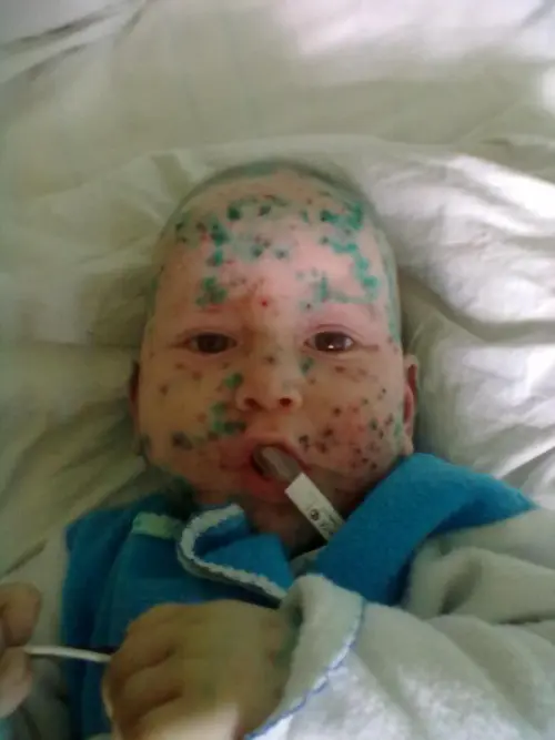 Профілактика вітрянки