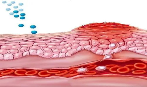 Механізм розвитку холодового дерматиту