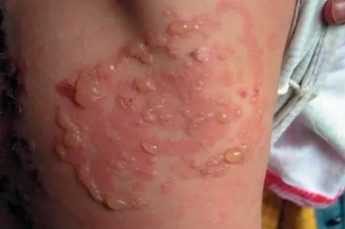 основные симптомы, которые помогут вам распознать аллергию и непереносимость