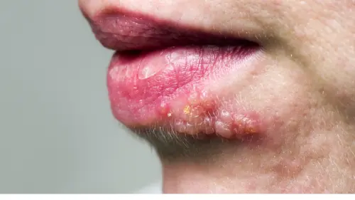 Ускладнення герпесу на губах