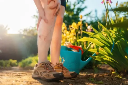 Чому варикозне розширення вен загострюється влітку