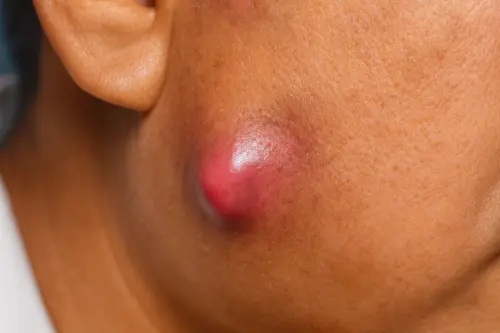 Чим небезпечний фурункул: можливі ускладнення