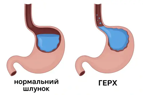 Причини ГЕРХ у дітей різного віку