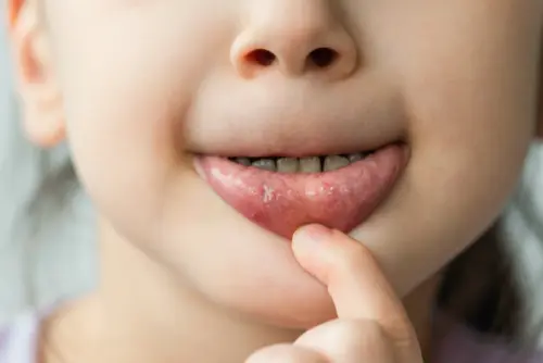 Лікування герпесу у дітей