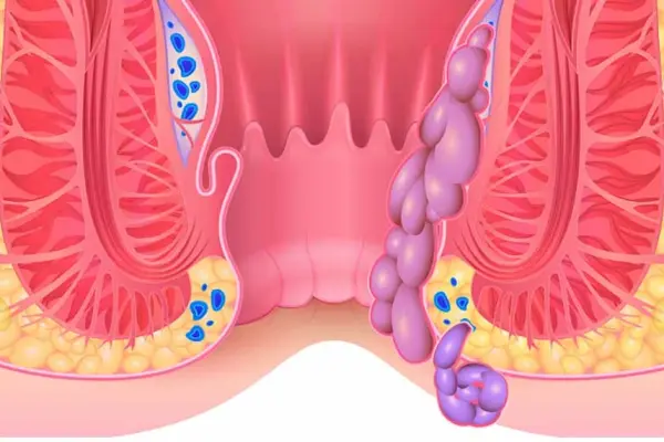 Симптоми геморою: як зрозуміти, що починається хвороба