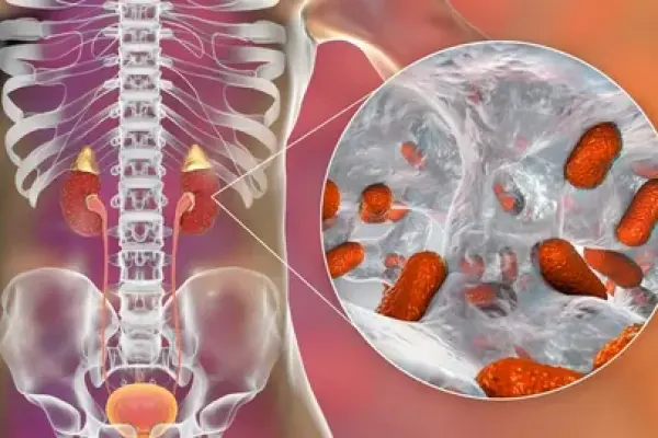 Пиелонефрит: симптомы и лечение воспаления почек