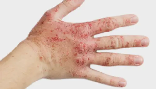 Що таке екзема і чому вона виникає?