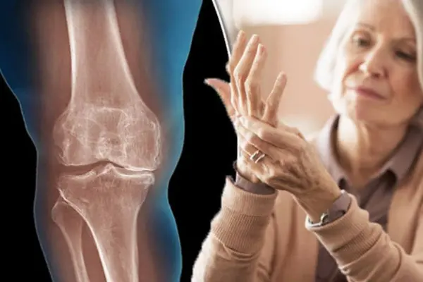 Как лечить артроз суставов: методы, которые работают