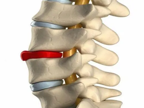 Протрузія та грижа міжхребцевих дисків