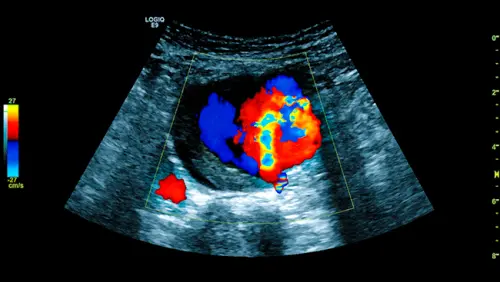 Як проходить дуплексне сканування аорти