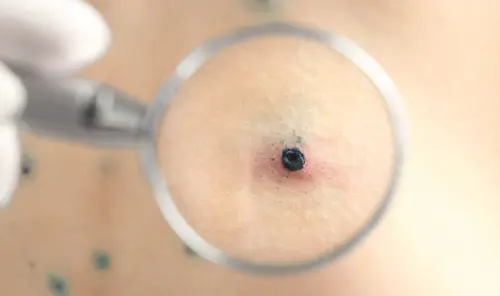 Діагностика вітряної віспи