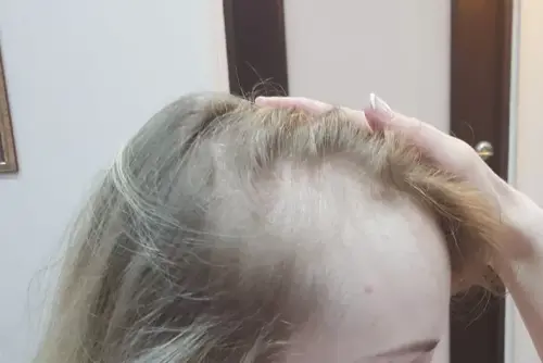 Послеродовое поредение волос