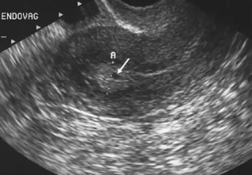Отримання та інтерпретація результатів цервікометрії