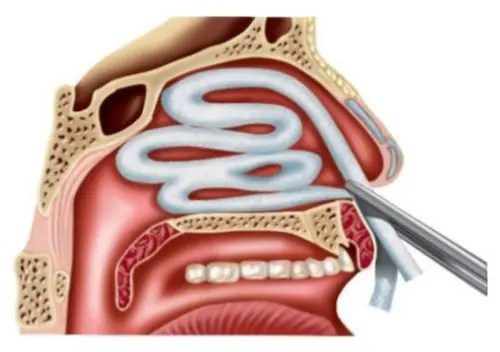 Что такое передняя тампонада носа?
