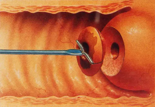 Що таке біопсія шийки матки