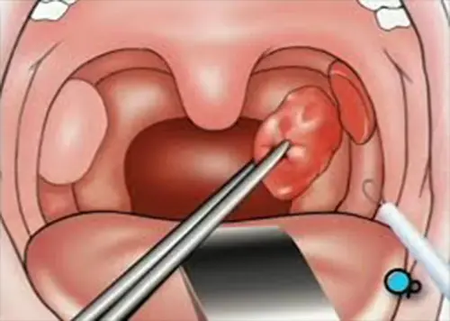 Що таке видалення стороннього тіла з глотки