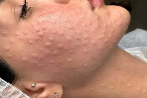 Что такое мезотерапия