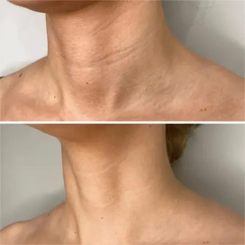 После проведения процедур для декольте и шеи