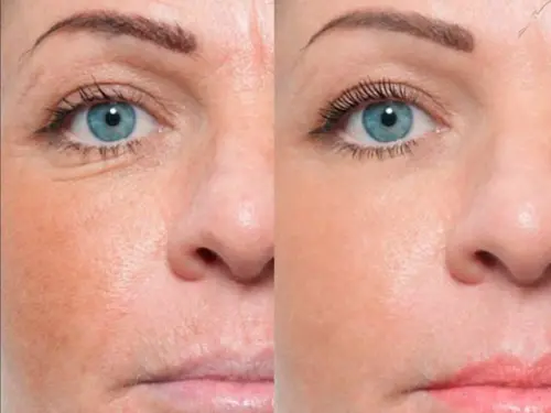 Что нужно знать после процедуры биоревитализации