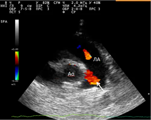 Як проходить ехо серця дитині