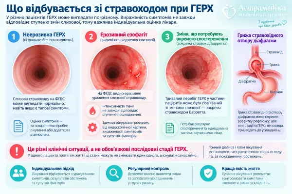 Неерозивна ГЕРХ, ерозивний езофагіт і зміни слизової стравоходу при рефлюксі