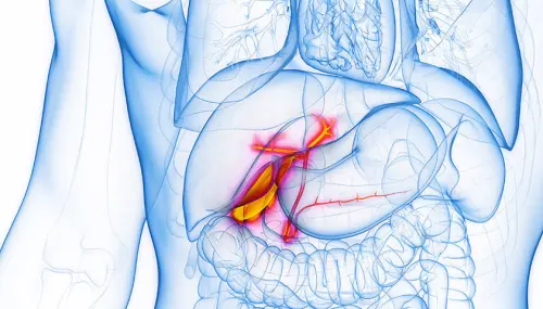 Що таке холецистит