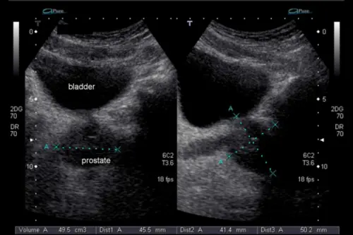 Отримання та інтерпретація результатів УЗД простати