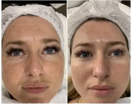 Что нужно знать после процедуры мезотерапии