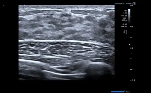 Получение результатов и расшифровка УЗИ молочной железы