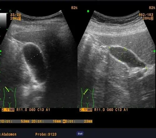 Получение и интерпретация результатов после УЗИ брюшной полости