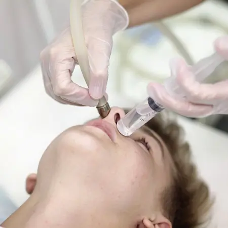 Як проходить промивання пазух носа за методом Проєтца?