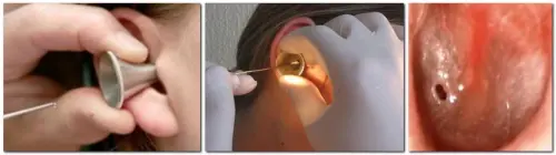 Что такое парацентез барабанной перепонки