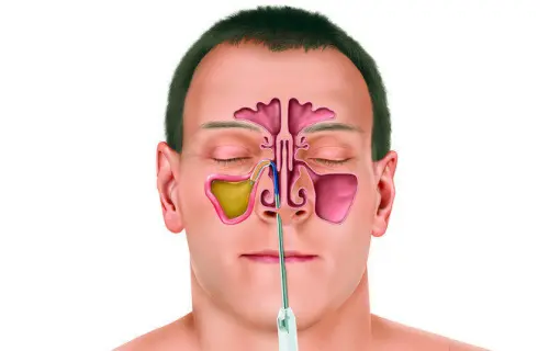 Що таке пункція гайморової пазухи