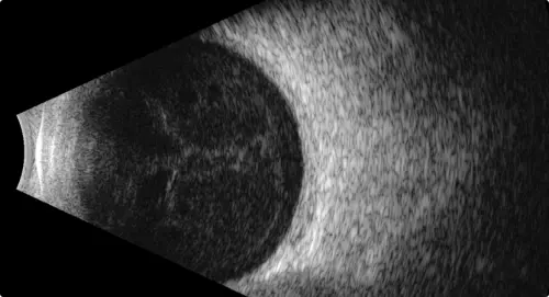 Як проходить УЗД ока