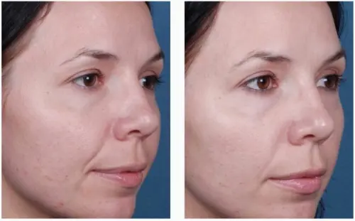 Що потрібно знати після процедури пілінгу