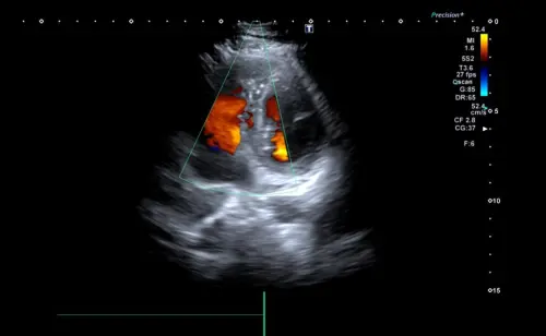 Как проходит УЗИ сердца