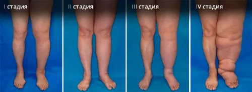 Симптоми та види набряків ніг