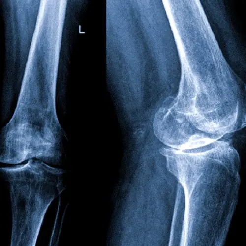 Результати УЗД суглобів: отримання та розшифрування