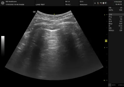 Получение и интерпретация результатов УЗИ легких