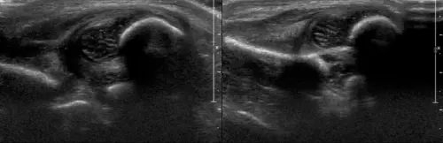 Как проходит УЗИ тазобедренных суставов у грудничка