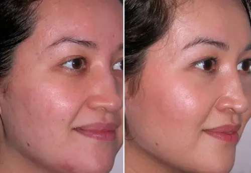 Электропорация до и после