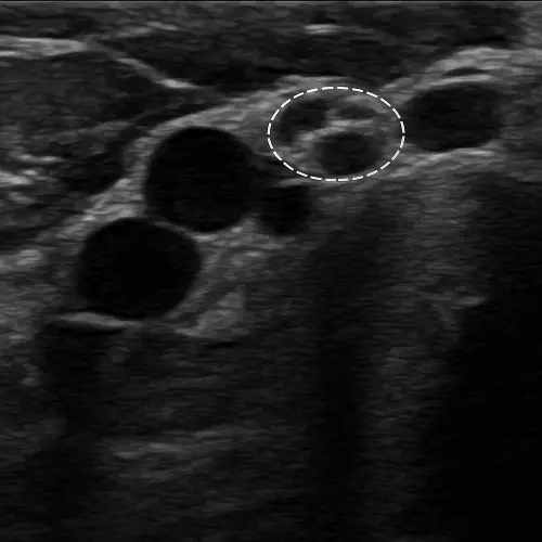 диагностика при УЗИ нервов