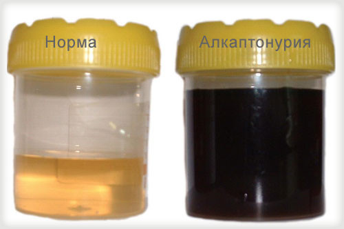 Чорна сеча: алкаптонурія та меланома