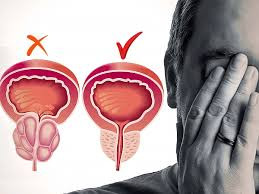 Лікування простатиту