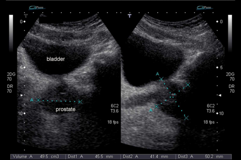 Получение и интерпретация результатов УЗИ простаты